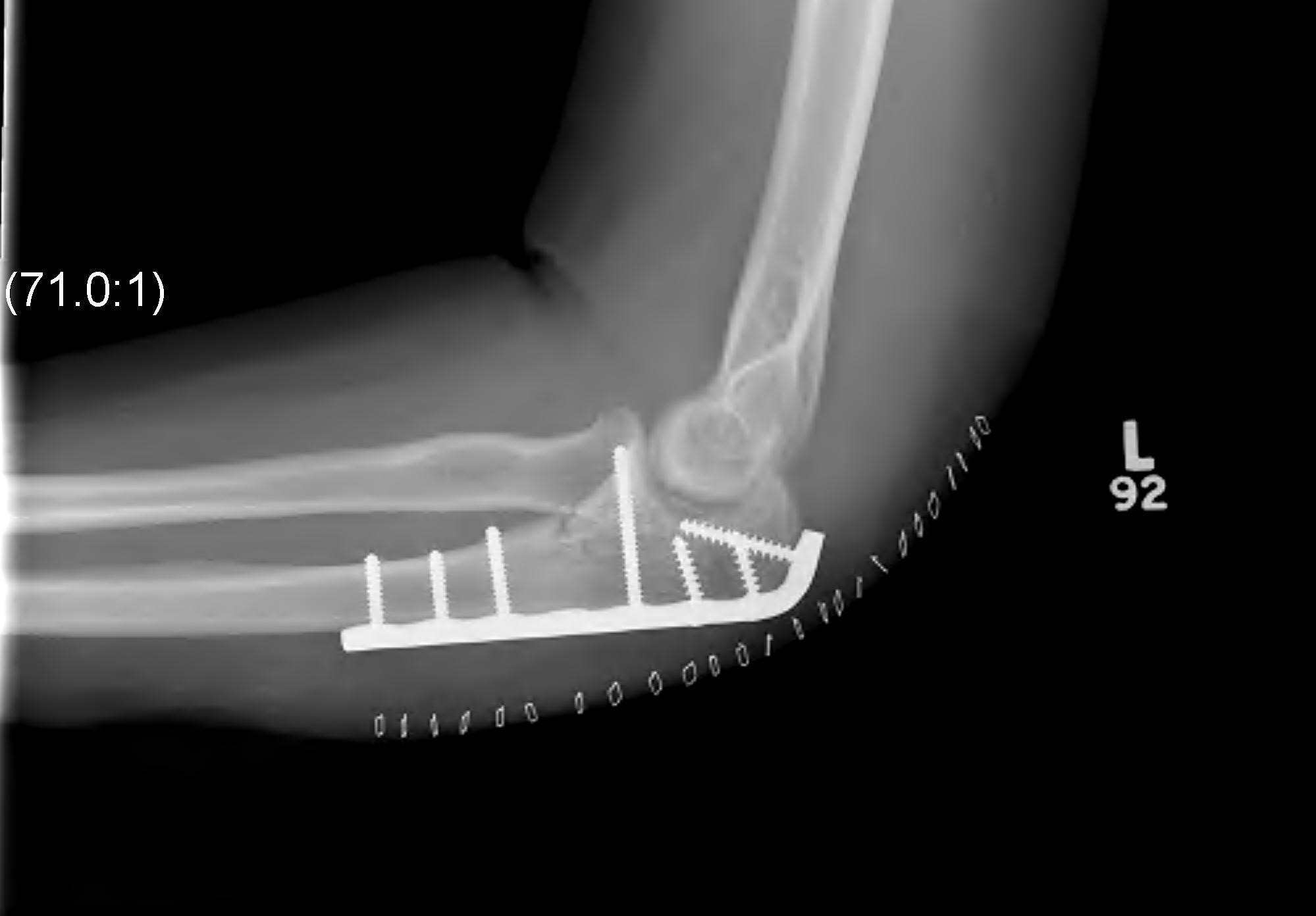 Elbow Monteggia Fracture ORIF